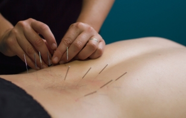 Phương pháp châm cứu chữa đau thần kinh tọa