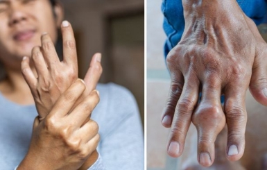 Chữa Viêm Khớp Dạng Thấp Bằng Y Học Cổ Truyền: An Toàn, Hiệu Quả Và Lâu Dài