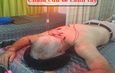 Tác dụng của châm cứu là gì?