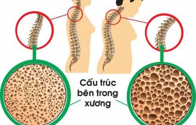 Bệnh loãng xương: Nguyên nhân, triệu chứng và cách điều trị hiệu quả