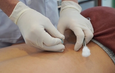 Cấy chỉ chữa thoát vị đĩa đệm: Giải pháp điều trị không xâm lấn từ Y học cổ truyền