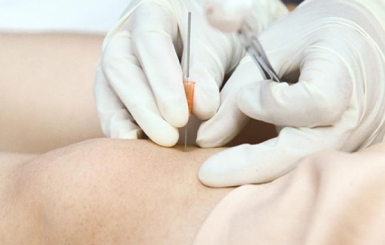 Cấy chỉ chữa đau khớp gối: Giải pháp phục hồi vận động từ Y học cổ truyền