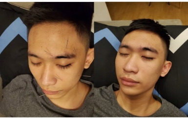 Châm cứu chữa liệt dây thần kinh số 7 phục hồi nhanh tại Đông Y Hoa Sen