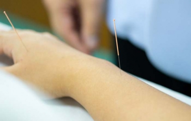 Châm cứu chữa tê bì chân tay có thực sự hiệu quả?