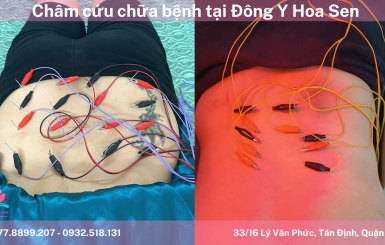 Châm cứu có làm bạn bị đau?