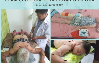 Châm cứu có tác dụng gì?