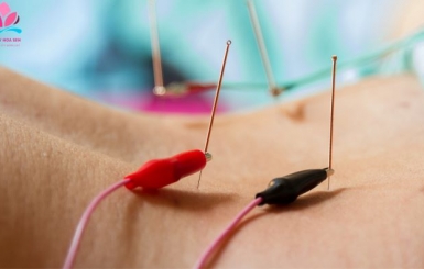Châm cứu đau lưng: Phương pháp cổ truyền, hiệu quả hiện đại