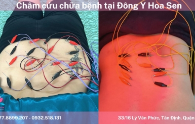 Châm cứu đau vai gáy chất lượng tại Đông Y Hoa Sen