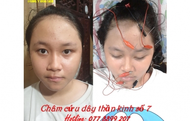 Phục Hồi Méo Miệng, Liệt Mặt Bằng Đông Y – Giải Pháp An Toàn, Không Tác Dụng Phụ