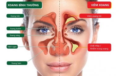 Phương pháp châm cứu điều trị viêm mũi xoang hiệu quả