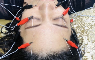 Châm cứu liệt dây thần kinh số 7 – Giải pháp tự nhiên cho sự phục hồi