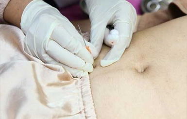 Cấy Chỉ Giảm Béo Bụng