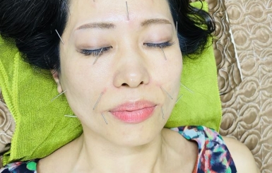 Chữa liệt dây thần kinh số 7 bằng đông y: Phương pháp hiệu quả và an toàn