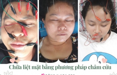 Chữa liệt dây thần kinh số 7 ở đâu an toàn hiệu quả?