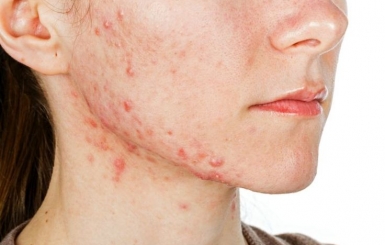 Mụn Trứng Cá: Nguyên Nhân, Triệu Chứng và Cách Điều Trị Hiệu Quả