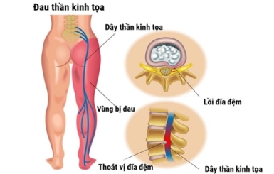 Cách chữa đau thần kinh tọa bằng bấm huyệt tại Đông Y Hoa Sen