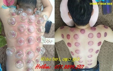 Đông Y Hoa Sen – Địa chỉ cạo gió giác hơi TPHCM đáng tin cậy