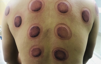 Bạn đã biết giác hơi ở đâu uy tín giá cả phải chăng?