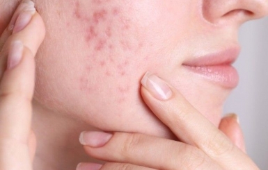 Bài Thuốc Cổ Phương Chữa Mụn – Giải Pháp Từ Đông Y Cho Làn Da Khỏe Đẹp