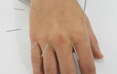 Châm Cứu Bấm Huyệt Chữa Viêm Khớp Dạng Thấp Có Hiệu Quả Không?