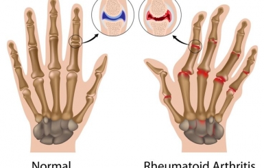 Bệnh Viêm Khớp: Nguyên Nhân, Triệu Chứng, Biến Chứng và Địa Chỉ Điều Trị Hiệu Quả
