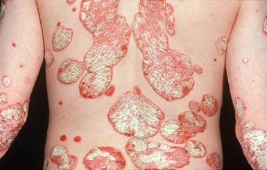 Giải pháp Đông y cho làn da bị chàm – Điều trị an toàn từ gốc đến ngọn