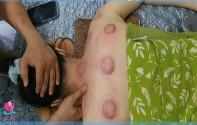 Chữa bệnh hiệu quả với các huyệt vùng cổ gáy tại địa chỉ đáng tin nào?