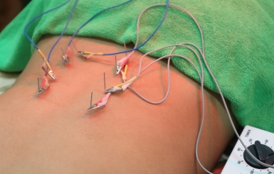 Châm Cứu Chữa Đau Lưng – Giải Pháp Đông Y An Toàn, Hiệu Quả