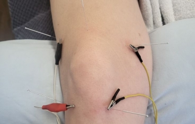 Châm Cứu Bấm Huyệt Chữa Thoái Hóa Khớp Có Hiệu Quả Không?