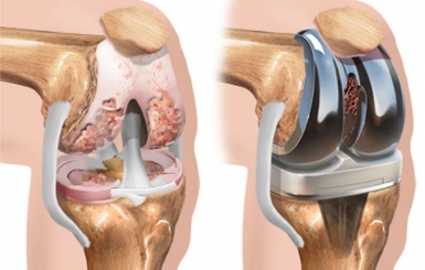Bệnh thoái hóa khớp: Nguyên nhân, triệu chứng và cách điều trị
