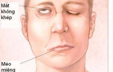 Hiểu rõ về liệt dây thần kinh số 7 và những điều cần biết