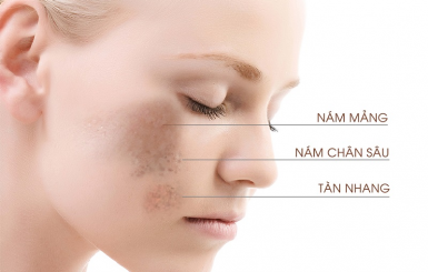 Bệnh Nám Da – Nguyên Nhân, Triệu Chứng và Cách Điều Trị Hiệu Quả Bằng Đông Y