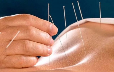 Mách bạn những điều kiêng cử khi châm cứu