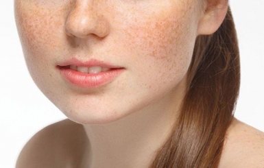 Thuốc Bắc Trị Nám Da – Liệu Pháp An Toàn Từ Bên Trong