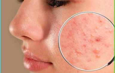 Tổng Quan Bệnh Lý Mụn: Nguyên Nhân, Biểu Hiện và Cách Điều Trị Hiệu Quả