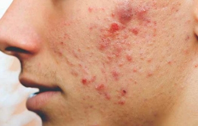 Giải pháp từ Đông y giúp điều trị mụn trứng cá an toàn, không tái phát