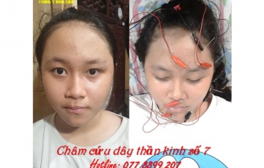 Nơi khám liệt dây thần kinh số 7 với phương pháp Đông Y hiệu quả
