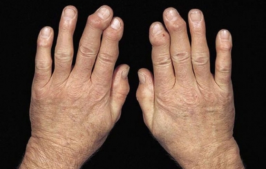 Viêm Khớp Dạng Thấp: Nguyên Nhân, Triệu Chứng và Phương Pháp Điều Trị