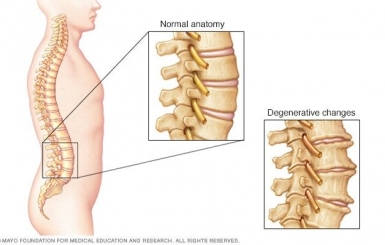 Điều trị gai cột sống bằng Đông y: An toàn – Hiệu quả – Không lo tái phát