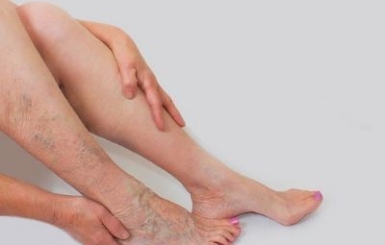 Vai trò của bấm huyệt trong hỗ trợ giảm triệu chứng suy giãn tĩnh mạch