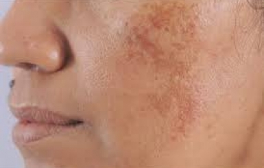 Địa Chỉ Bán Thuốc Bắc Trị Nám Da Uy Tín, Hiệu Quả Tại TP.HCM