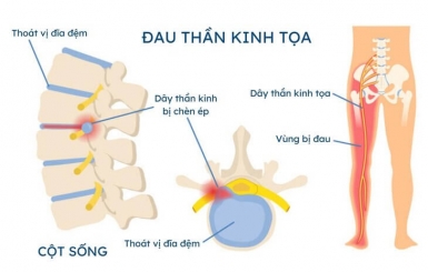 Bị Đau Thần Kinh Tọa Có Nguy Hiểm Không?