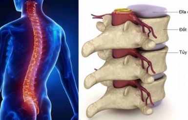 Cách điều trị thoái hóa cột sống lưng và các lưu ý cần thiết