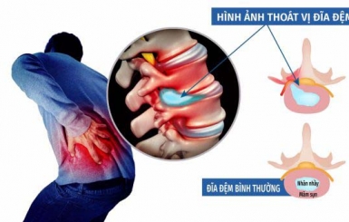 Thoát vị đĩa đệm châm cứu có tốt không? 