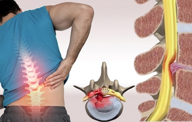 Vì sao bị thoát vị đĩa đệm?