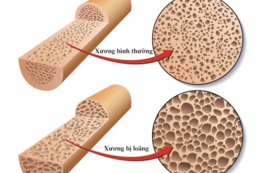 Phương pháp điều trị loãng xương hiệu quả hiện nay