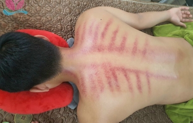 Lợi ích không tưởng của việc cạo gió, giác hơi