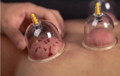 Chích Lễ Là Gì? Công Dụng Tuyệt Vời Của Chích Lễ Trong Y Học Cổ Truyền