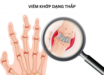 Điều Trị Viêm Khớp Dạng Thấp Bằng Đông Y – Hiệu Quả, An Toàn Tại Phòng Khám Đông Y Hoa Sen