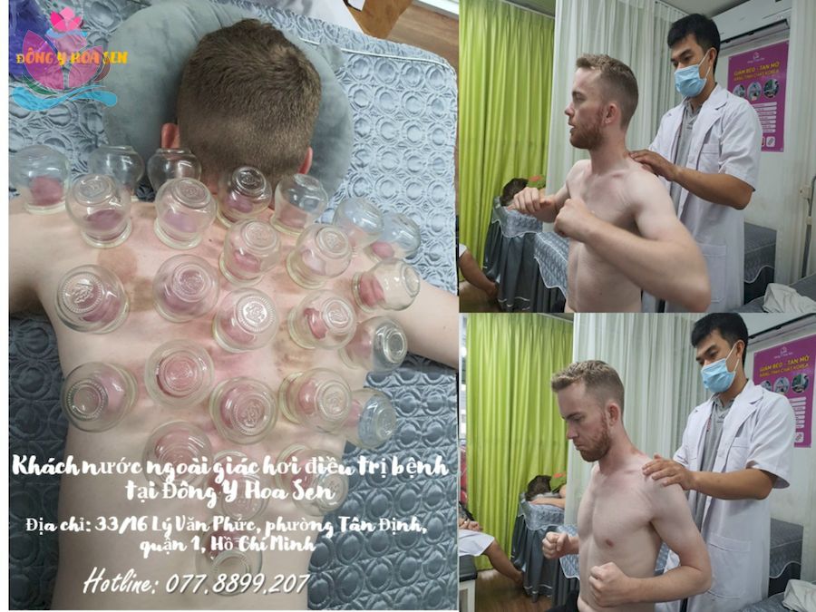 International visitor receiving cupping and shoulder care at Dong Y Hoa Sen